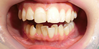 元気白い歯の素（GSE練歯みがき） | びんちょうたんコム